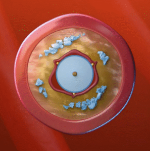 AngioSculpt - Philips 2